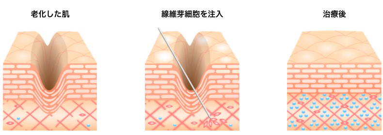 深度解析干细胞、上清液与纤维芽细胞