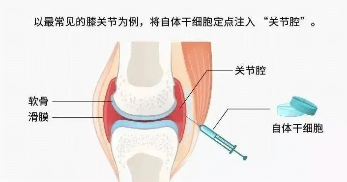 拍片子没事，膝盖却生疼？JIIWHA“微环境评估”：揪出连核磁共振都看不到的“隐形刺”