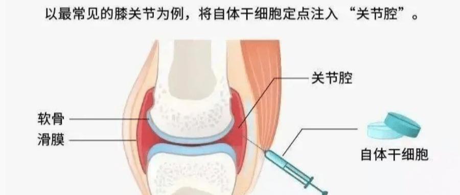 连爱马仕都提不动?胳膊肘疼到钻心的CFO